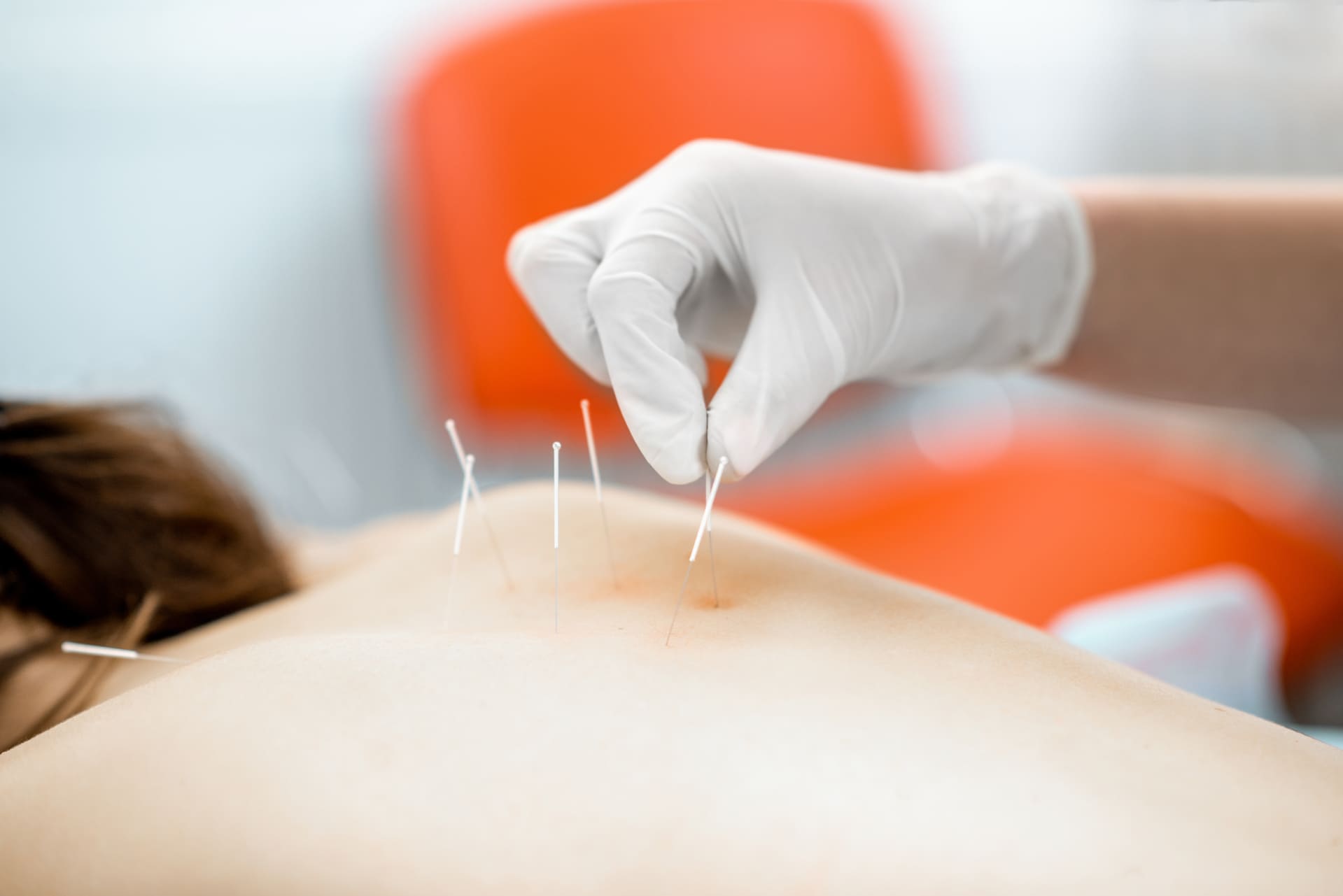 Acupuntura